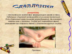Сдавления (compressio) —это длительное воздействие травмирующего агента на ткани