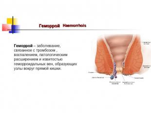 Геморрой Haemorrhois Геморрой – заболевание, связанное с тромбозом , воспалением