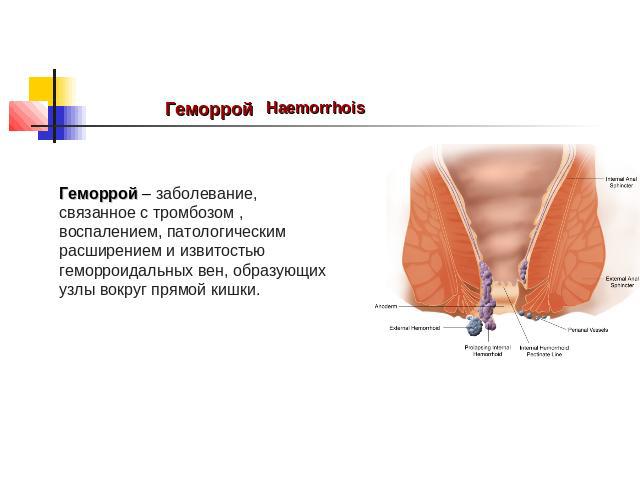 Геморрой Haemorrhois Геморрой – заболевание, связанное с тромбозом , воспалением, патологическим расширением и извитостью геморроидальных вен, образующих узлы вокруг прямой кишки.