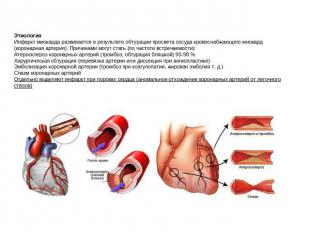 ЭтиологияИнфаркт миокарда развивается в результате обтурации просвета сосуда кро
