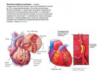 Механизм инфаркта миокарда — разрыв атеросклеротической бляшки, часто при умерен