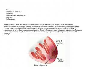 ПатогенезРазличают стадии:ИшемииПовреждения (некробиоза)НекрозаРубцевания Ишемия
