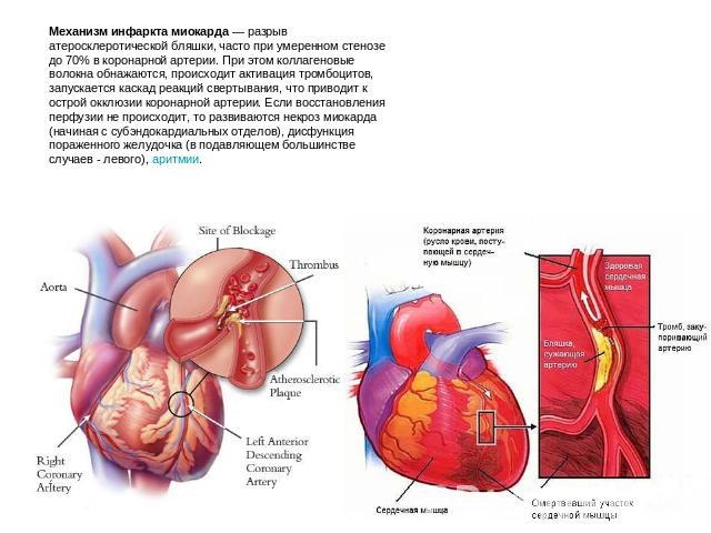 Механизм инфаркта миокарда — разрыв атеросклеротической бляшки, часто при умеренном стенозе до 70% в коронарной артерии. При этом коллагеновые волокна обнажаются, происходит активация тромбоцитов, запускается каскад реакций свертывания, что приводит…