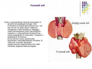 Узловой зоб  Узлы в щитовидной железе возникают в результате дефицита йода. Они