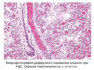 Микрофотография диффузного поражения альвеол при РДС. Окраска гематоксилином и э