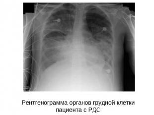 Рентгенограмма органов грудной клетки пациента с РДС