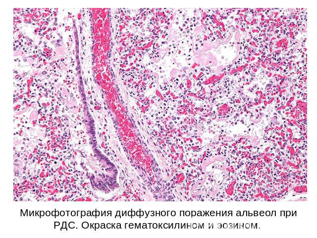 Микрофотография диффузного поражения альвеол при РДС. Окраска гематоксилином и эозином.