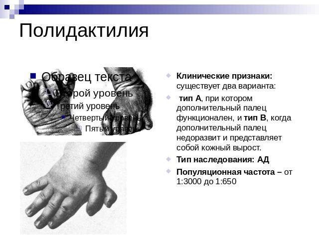 Полидактилия Клинические признаки: существует два варианта: тип А, при котором дополнительный палец функционален, и тип В, когда дополнительный палец недоразвит и представляет собой кожный вырост.Тип наследования: АДПопуляционная частота – от 1:3000…
