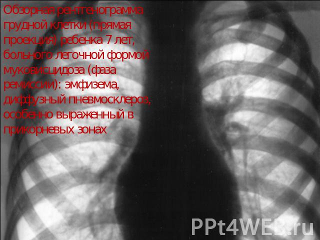 Обзорная рентгенограмма грудной клетки (прямая проекция) ребенка 7 лет, больного легочной формой муковисцидоза (фаза ремиссии): эмфизема, диффузный пневмосклероз, особенно выраженный в прикорневых зонах