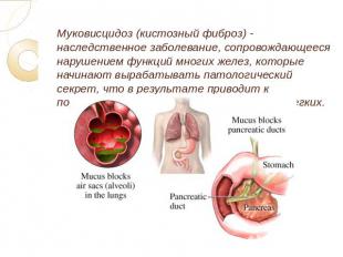 Муковисцидоз (кистозный фиброз) - наследственное заболевание, сопровождающееся н