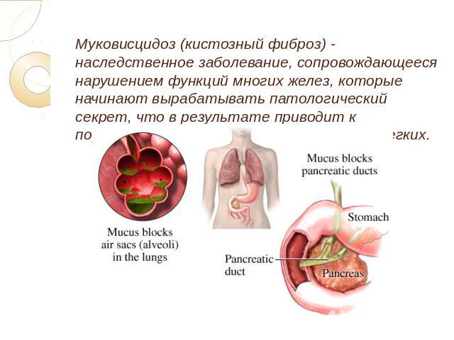 Муковисцидоз (кистозный фиброз) - наследственное заболевание, сопровождающееся нарушением функций многих желез, которые начинают вырабатывать патологический секрет, что в результате приводит к поражению пищеварительного тракта и легких.