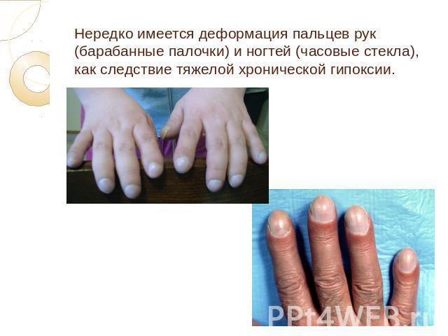 Нередко имеется деформация пальцев рук (барабанные палочки) и ногтей (часовые стекла), как следствие тяжелой хронической гипоксии.