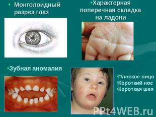 Монголоидный разрез глаз Характерная поперечная складка на ладони Зубная аномали
