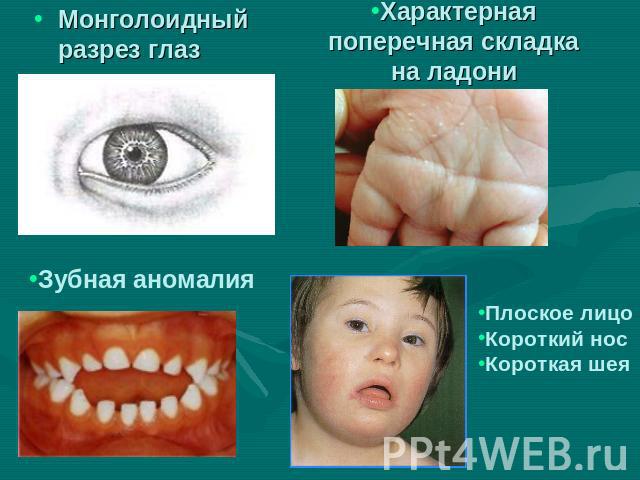 Монголоидный разрез глаз Характерная поперечная складка на ладони Зубная аномалия Плоское лицоКороткий носКороткая шея