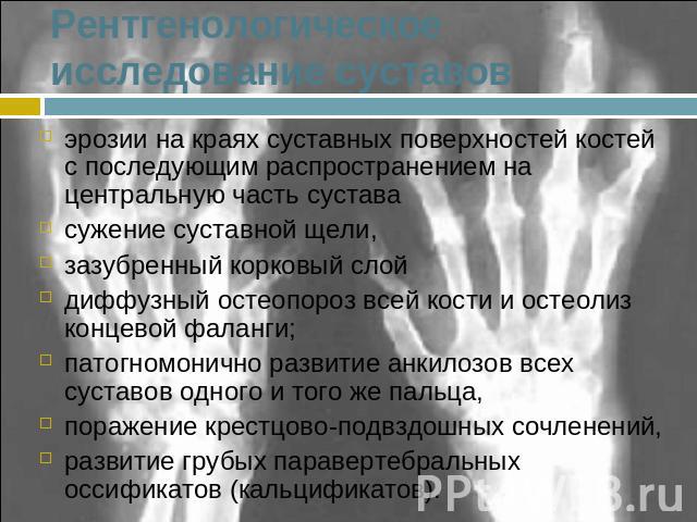 Рентгенологическое исследование суставов эрозии на краях суставных поверхностей костей с последующим распространением на центральную часть суставасужение суставной щели, зазубренный корковый слойдиффузный остеопороз всей кости и остеолиз концевой фа…