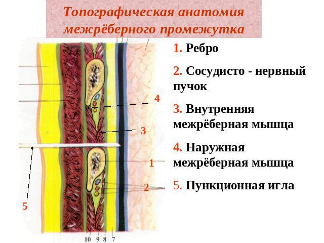 Топографическая анатомия межрёберного промежутка 1. Ребро2. Сосудисто - нервный пучок3. Внутренняя межрёберная мышца4. Наружная межрёберная мышца5. Пункционная игла