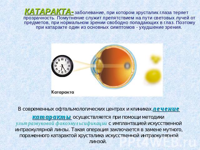 КАТАРАКТА- заболевание, при котором хрусталик глаза теряет прозрачность. Помутнение служит препятствием на пути световых лучей от предметов, при нормальном зрении свободно попадающих в глаз. Поэтому при катаракте один из основных симптомов - ухудшен…