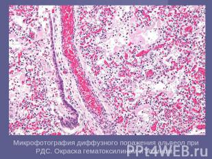 Микрофотография&nbsp;диффузного поражения альвеол при РДС.&nbsp;Окраска гематокс