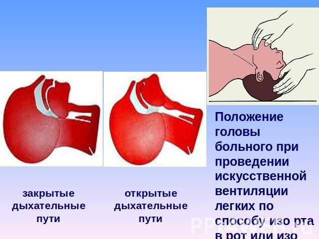 Положение головы больного при проведении искусственнойвентиляции легких по способу изо рта в рот или изо рта в нос. закрытыедыхательные пути открытыедыхательные пути