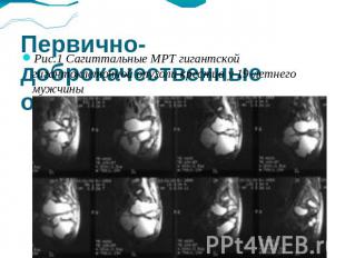 Первично-доброкачественные опухоли позвоночника Рис.1 Сагиттальные МРТ гигантско