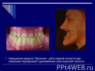 Нарушения прикуса: Прогения - зубы нижней челюсти при смыкании перекрывают однои