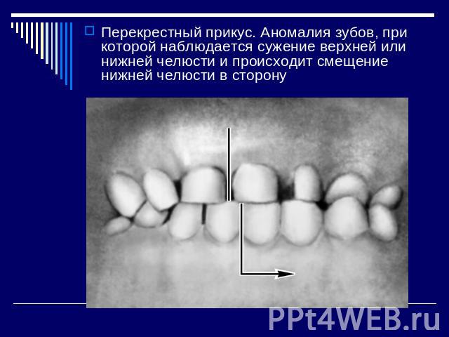 Перекрестный прикус. Аномалия зубов, при которой наблюдается сужение верхней или нижней челюсти и происходит смещение нижней челюсти в сторону