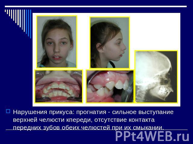 Нарушения прикуса: прогнатия - сильное выступание верхней челюсти кпереди, отсутствие контакта передних зубов обеих челюстей при их смыкании.