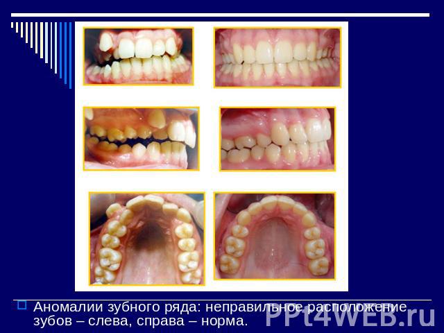 Аномалии зубного ряда: неправильное расположение зубов – слева, справа – норма.