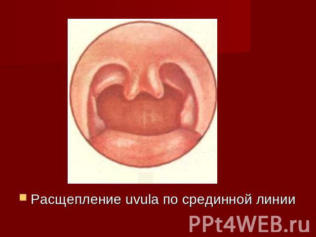 Расщепление uvula по срединной линии