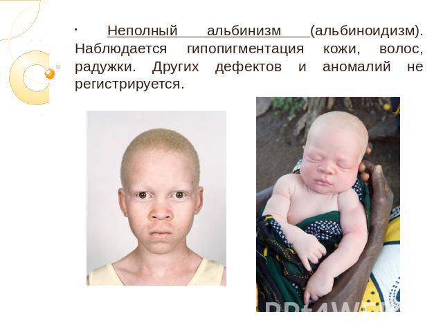 Неполный альбинизм (альбиноидизм). Наблюдается гипопигментация кожи, волос, радужки. Других дефектов и аномалий не регистрируется.