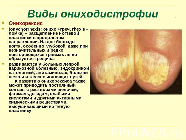 Виды ониходистрофии Онихорексис (onychorrhexis; онихо +греч. rhexis - ломка) – расщепление ногтевой пластинки в продольном направлении. На дне борозды ногтя, особенно глубокой, даже при незначительных и редко повторяющихся травмах легко образуется т…