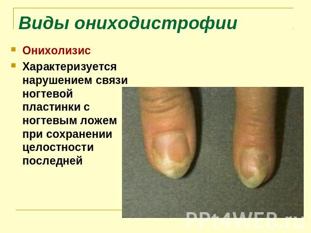 Виды ониходистрофии Онихолизис Характеризуется нарушением связи ногтевой пластинки с ногтевым ложем при сохранении целостности последней