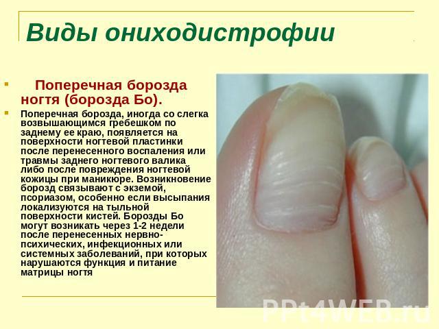 Виды ониходистрофии      Поперечная борозда ногтя (борозда Бо). Поперечная борозда, иногда со слегка возвышающимся гребешком по заднему ее краю, появляется на поверхности ногтевой пластинки после перенесенного воспаления или…