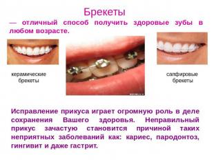 Брекеты — отличный способ получить здоровые зубы в любом возрасте. Исправление п