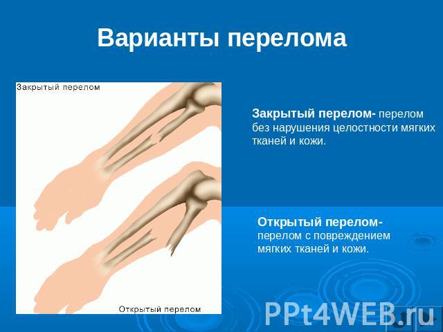 Варианты перелома Закрытый перелом- перелом без нарушения целостности мягких тканей и кожи. Открытый перелом- перелом с повреждением мягких тканей и кожи.