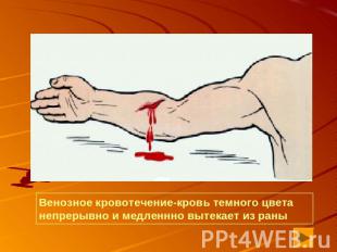Венозное кровотечение-кровь темного цвета непрерывно и медленнно вытекает из ран