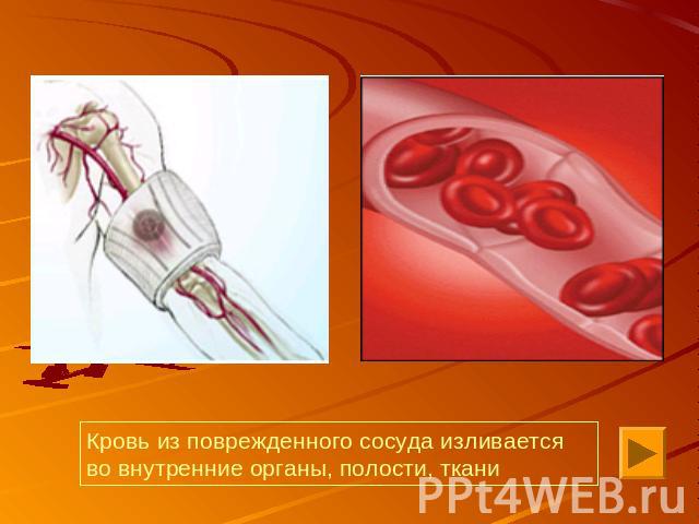 Кровь из поврежденного сосуда изливается во внутренние органы, полости, ткани