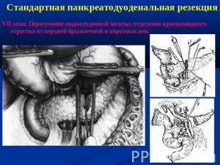 Стандартная панкреатодуоденальная резекцияVII этап: Пересечение поджелудочной же