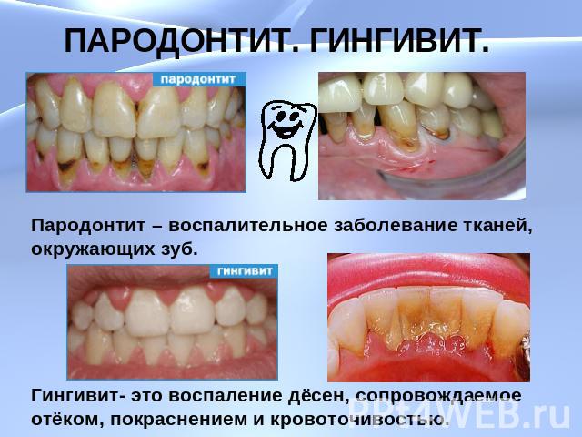 ПАРОДОНТИТ. ГИНГИВИТ.Пародонтит – воспалительное заболевание тканей, окружающих зуб.Гингивит- это воспаление дёсен, сопровождаемое отёком, покраснением и кровоточивостью.