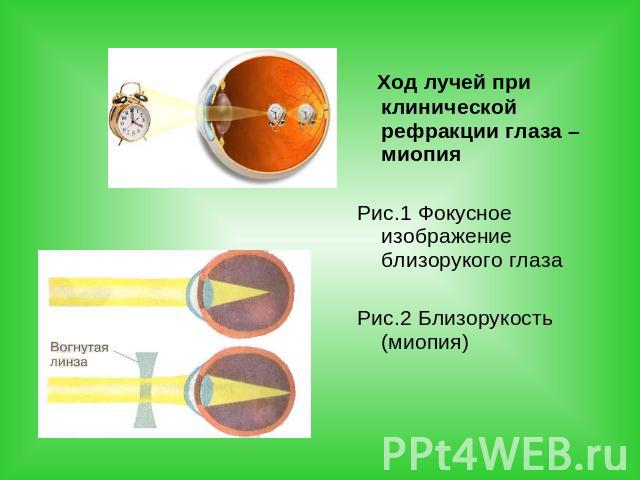 Ход лучей при клинической рефракции глаза – миопия Рис.1 Фокусное изображение близорукого глазаРис.2 Близорукость (миопия)