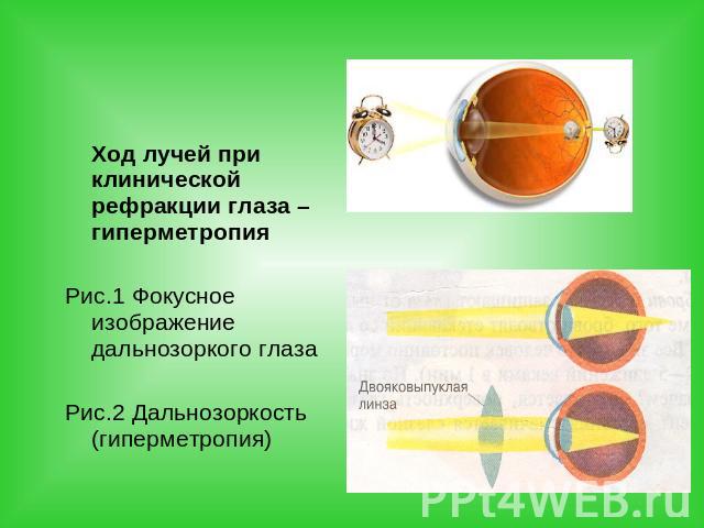 Ход лучей при клинической рефракции глаза – гиперметропия Рис.1 Фокусное изображение дальнозоркого глазаРис.2 Дальнозоркость (гиперметропия)
