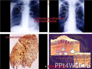 Воспаление лёгких на рентгенограмме Лёгкие курильщикабронхит