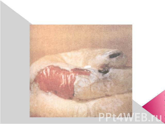 Электроожог III—IV степени I и II пальцев: после удаления части некротизированной кожи обнажилась красная раневая поверхность, окруженная серой некротически измененной кожей; участки черного цвета — очаги сухого некроза.
