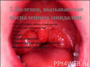 5.Болезни, вызываемые воспалением миндалин.Гипертрофия нёбных миндалинТонзиллит