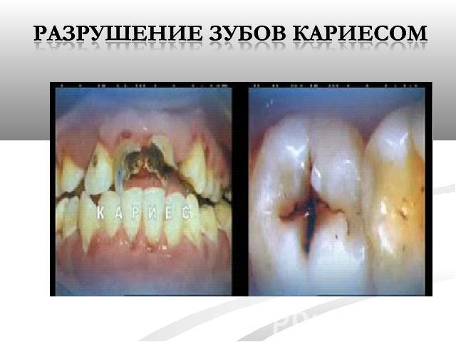 Разрушение зубов кариесом