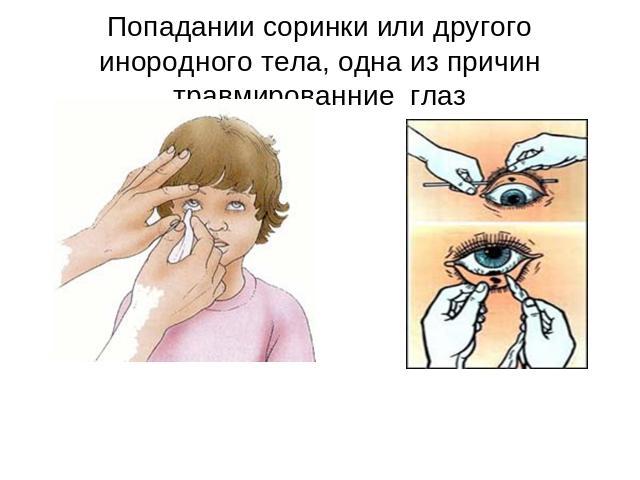 Попадании соринки или другого инородного тела, одна из причин травмированние глаз