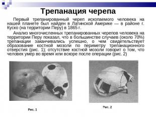 Трепанация черепа Первый трепанированный череп ископаемого человека на нашей пла