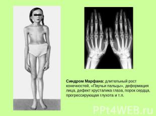 Синдром Марфана: длительный рост конечностей, «Паучьи пальцы», деформация лица,