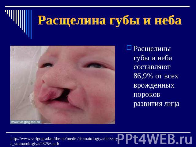 Расщелина губы и неба Расщелины губы и неба составляют 86,9% от всех врожденных пороков развития лица