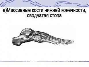 е)Массивные кости нижней конечности, сводчатая стопа